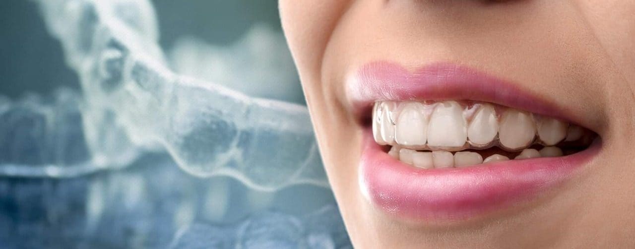 Invisalign sorriso perfeito